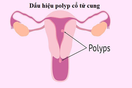 Dấu hiệu polyp cổ tử cung
