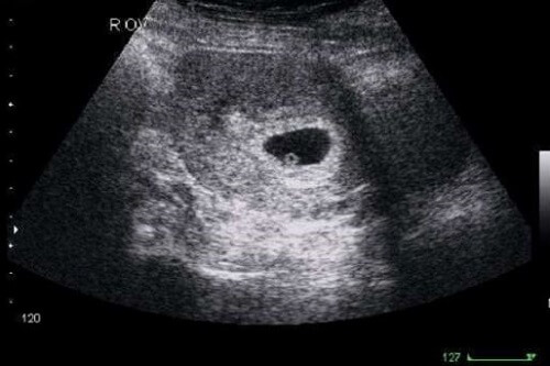 Hình ảnh siêu âm thai 4 tuần