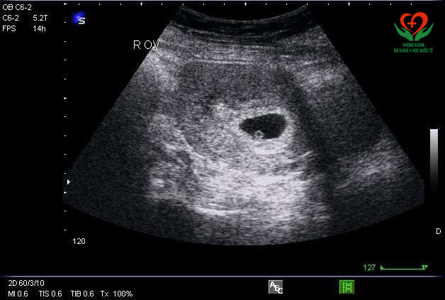 Hình ảnh siêu âm thai 6 tuần tuổi