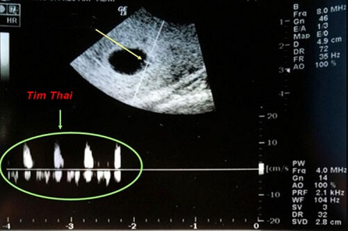 Siêu âm tim thai