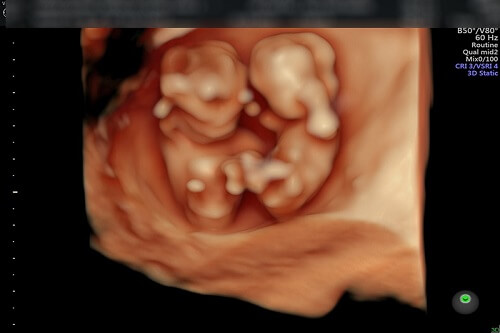 Hình ảnh siêu âm thai 4D từ 12-14 tuần
