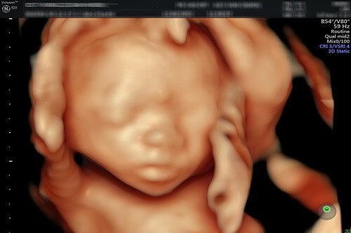Hình ảnh siêu âm thai 4D từ 20-22 tuần