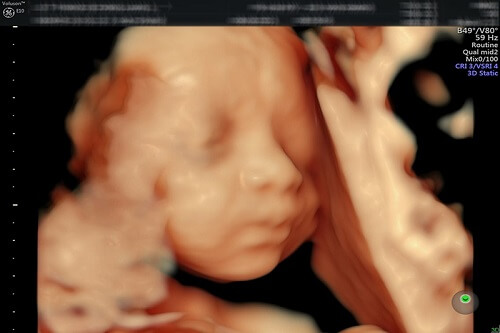 hình ảnh siêu âm 4D thai 27 tuần