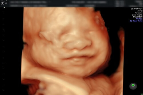 Đừng bỏ lỡ cơ hội nhìn thấy con yêu của bạn trong giai đoạn 28 tuần, với siêu âm 4D chân thực và sinh động. Chúng ta sẽ cùng chứng kiến hình ảnh thai nhi đáng yêu nhất với một trải nghiệm siêu âm đầy kỳ vĩ!
