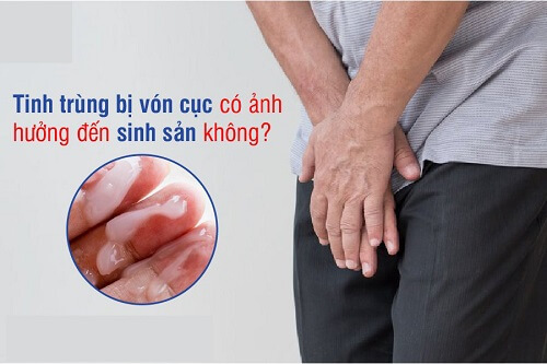 Tinh trùng vón cục có con được không