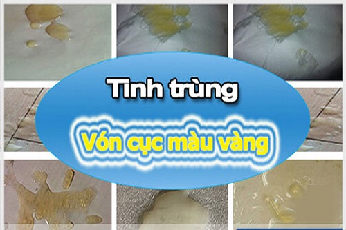 Tinh trùng vón cục màu vàng