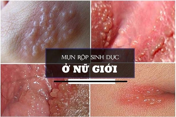 Bệnh mụn rộp sinh dục là gì, nguyên nhân, triệu chứng và cách điều trị