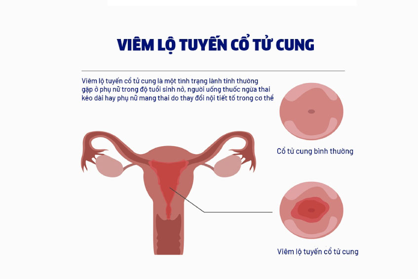 Viêm lộ tuyến cổ tử cung, tổng quan về bệnh viêm lộ tuyến