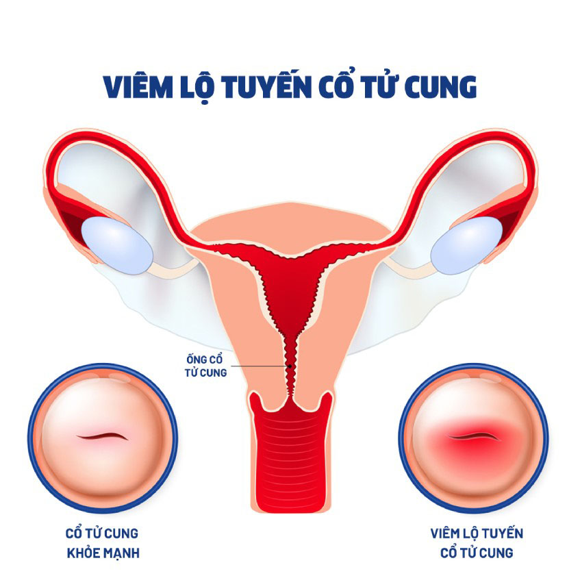 Viêm lộ tuyến cổ tử cung, tổng quan về bệnh viêm lộ tuyến